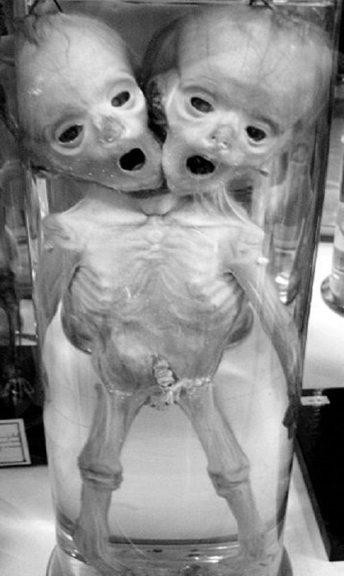 human conjoined twins at Musée Dupuytren