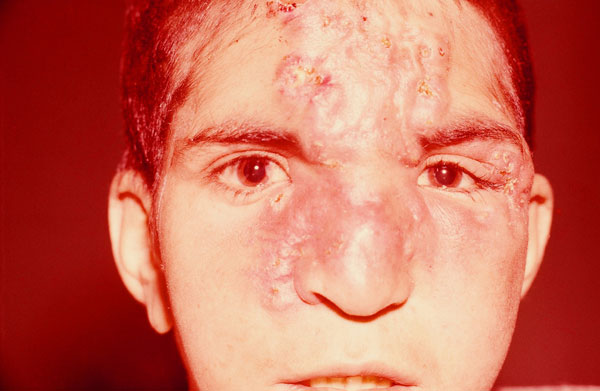 Infiltration Of Skin Due To Endemic Syphilis