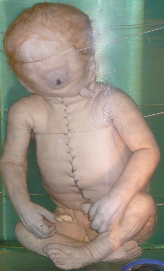 Child With Cyclopia