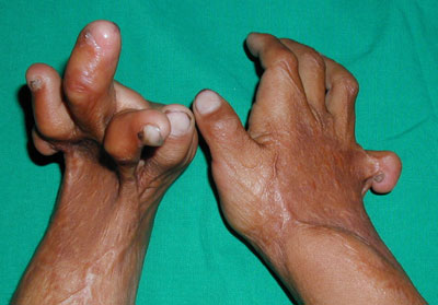 Post Burn Hand Deformity 