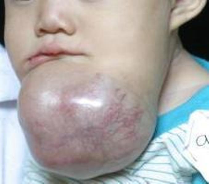 Child WithA Massive Ameloblastoma