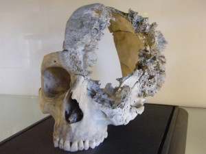 Sarcoma Skull
