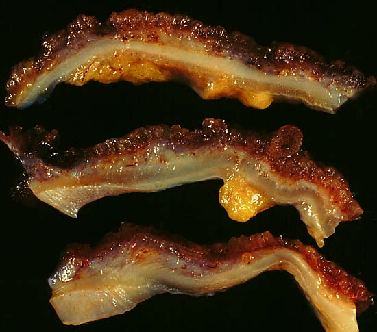 Close-up view of ulcerative colitis