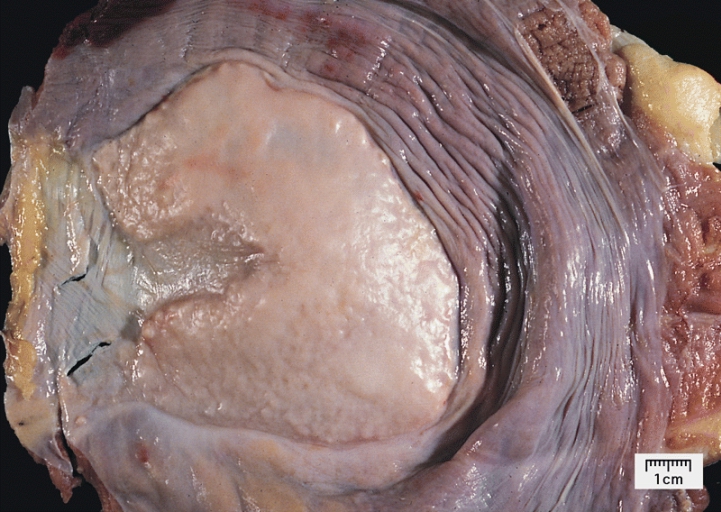 fibrous plaque on the thoracic diaphragm