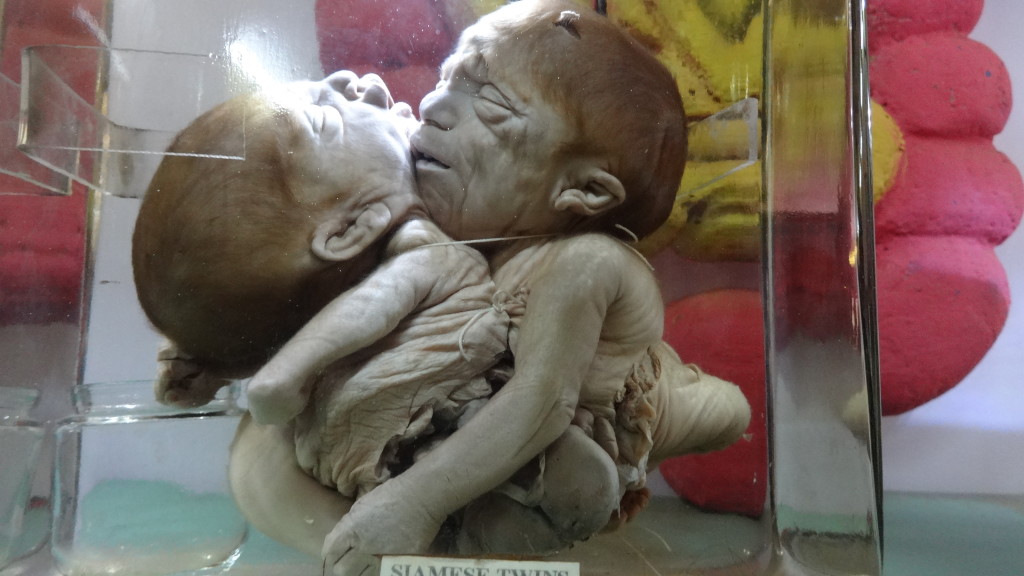 fetus Siamese twins 