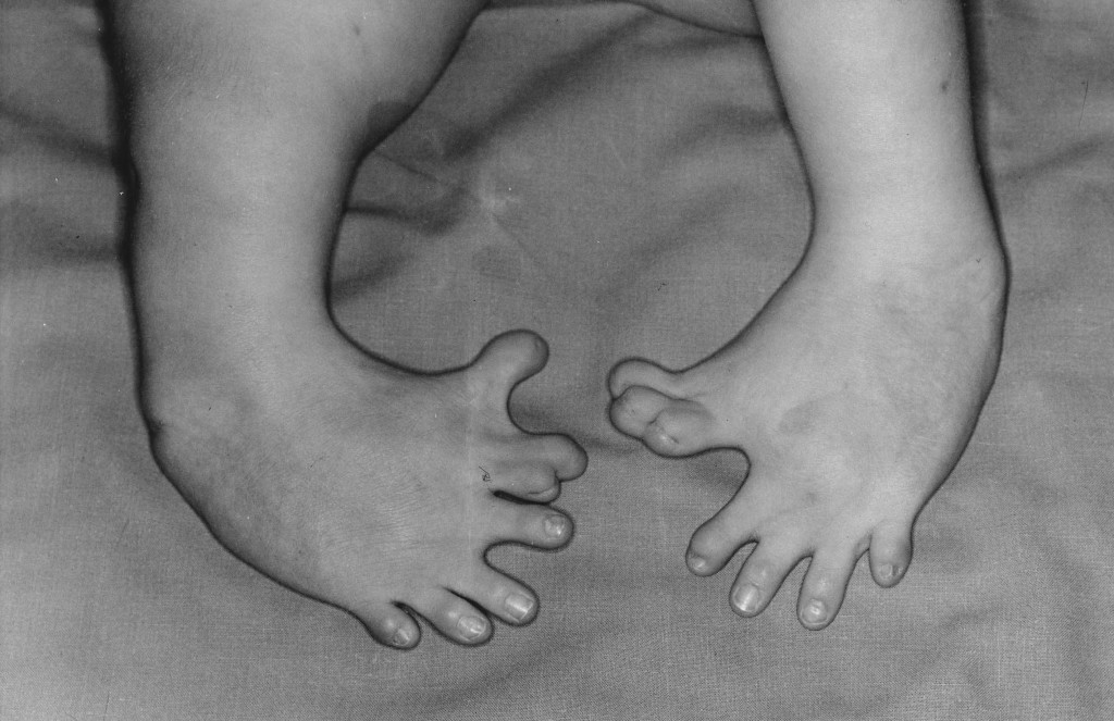 malformation of the feet 