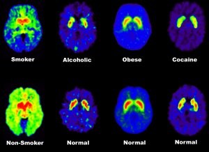 PET brain scan addicts
