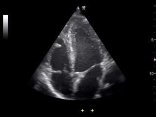 heart ultrasound 