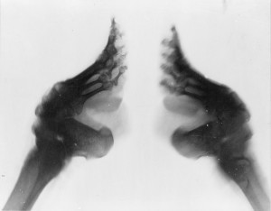 X-ray of two bound feet