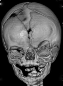 CT-scan Of A Skull Of A Patient With Coronal Synostosis