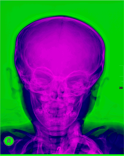 skull X-ray