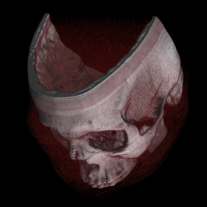 CT image of skull
