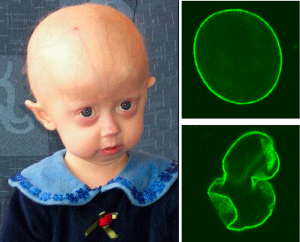 young girl with progeria