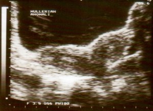 duplication of uterus corpus