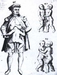 an adult man with a parasitic twin