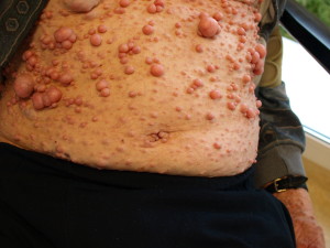 neurofibroma of the skin