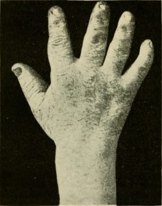 Acromegaly