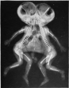 X-Ray of conjoined twins