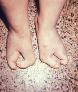 child with lobster claw feet