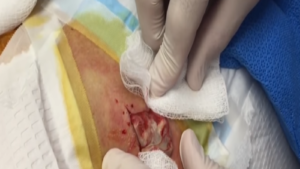 cyst popping video