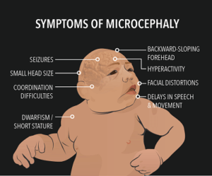 symptoms of microcephaly 