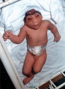1986 image of a baby with anencephaly 