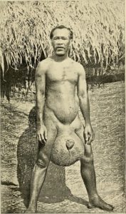 man with scrotal elephantiasis