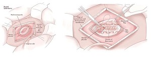 Fetal Surgery for Myelomeningocele