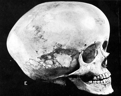 hydrocephalic skull