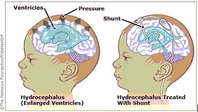 hydrocephalus treated with a shunt 