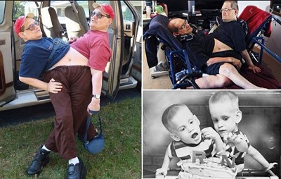oldest living conjoined twins
